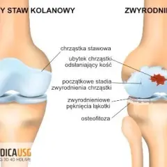 Choroba zwyrodnieniowa stawów: leki, suplementy i terapie. Co działa?