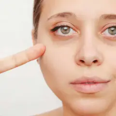 Primer dedo señala la zona debajo del ojo, mostrando ojeras vasculares.