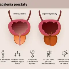 Porównanie zdrowej prostaty i zapalenia prostaty, z objawami takimi jak ból, problemy z oddawaniem moczu i zaburzenia erekcji.