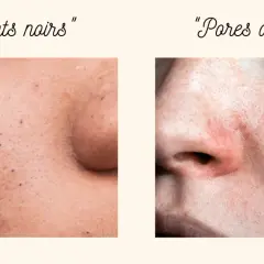 Comparaison de peau : points noirs et pores dilatés. Apprenez comment resserrer les pores pour une peau plus lisse.