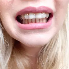 Uśmiech z dyskretnymi nakładkami Invisalign, które korygują zęby. Jasne włosy i różowe usta dopełniają całość.