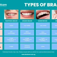Porównanie rodzajów aparatów ortodontycznych: tradycyjne, ceramiczne, Damon i Invisalign. Tabela zawiera informacje o widoczności, komforcie, czasie leczenia i częstotliwości wizyt.