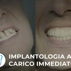 Prima e dopo: sorriso trasformato con implantologia a carico immediato. Valuta le controindicazioni per un risultato perfetto.