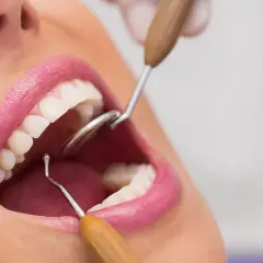Usta kobiety z białymi zębami, badane przez dentystę. Widoczna jest niewielka kieszonka dziąsłowa.