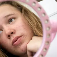 Nastolatka z trądzikiem ogląda swoją twarz w różowym lusterku.