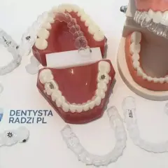 Modele szczęk z nakładkami ortodontycznymi. Zastanawiasz się, po jakim czasie widać pierwsze efekty aparatu ortodontycznego?
