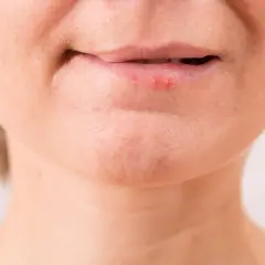 Labios con herpes, posiblemente por exposición al sol.