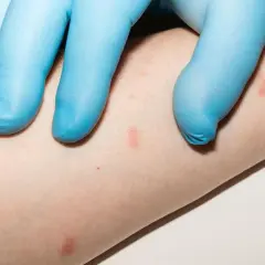 Mano con guanto blu esamina piccole lesioni cutanee rosse su un braccio, indicative di psoriasi guttata nei bambini.
