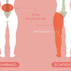 Illustration montrant la différence entre le lumbago et la sciatique, avec le nerf sciatique et la zone douloureuse.
