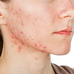 Visage avec acné légère sur la joue et le cou, une peau qui pourrait bénéficier de Roaccutane.