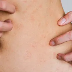 Zaburzenia hormonalne objawy skórne: co może oznaczać Twoja skóra?