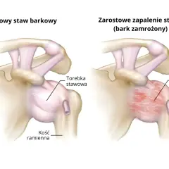 Porównanie zdrowego stawu barkowego z zapaleniem mięśnia barkowego (bark zamrożony), gdzie torebka stawowa jest pogrubiała i usztywniona.