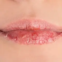 Labbra secche e screpolate, con pelle che si sfalda. Le cause possono essere molteplici, dal freddo alla disidratazione.