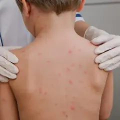 Ospa wietrzna: Bezpieczne leczenie, skuteczne maści i czego NIE podawać
