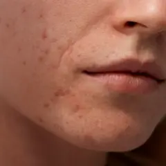 Gros plan sur le visage d'une femme montrant des imperfections et des rougeurs, typiques de l'acné de fin de grossesse.