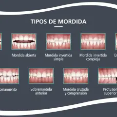 Ilustración de varios tipos de mordida dental, incluyendo una **mordida abierta** donde los dientes frontales no se tocan al cerrar la boca.
