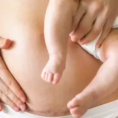 Blizna po cesarskim cięciu na brzuchu mamy, która tuli swoje dziecko. Krocze po porodzie jest w pełni widoczne.