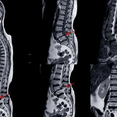 Rezonans magnetyczny kręgosłupa lędźwiowego pokazuje zmiany, które mogą odpowiadać za rwę kulszową. Czerwone strzałki wskazują na potencjalne przyczyny bólu.