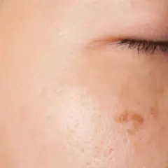 Primo piano del viso con macchie scure sulla pelle, alcune più evidenti vicino all'occhio.