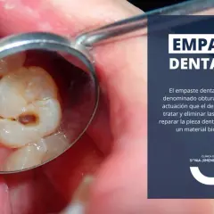 Reflejo en espejo dental de una muela con empaste, mostrando la cavidad tratada.