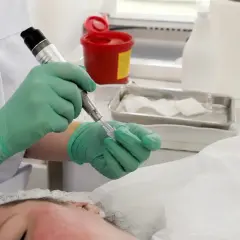 Dermapen zalecenia po zabiegu: specjalista w zielonych rękawiczkach przygotowuje urządzenie do mikronakłuwania skóry.