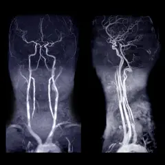 Angiografia tętnic szyjnych i mózgowych w dwóch projekcjach. Widoczne naczynia krwionośne głowy i szyi.