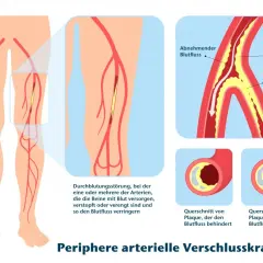Illustration zeigt PAVK: Plaque verengt Arterien im Bein, behindert Blutfluss. Gehtraining kann helfen.