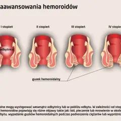 Ilustracja przedstawia cztery stopnie zaawansowania hemoroidów, od I do IV, pokazując stopniowe wypadanie odbytu i tworzenie się guzków hemoroidalnych.