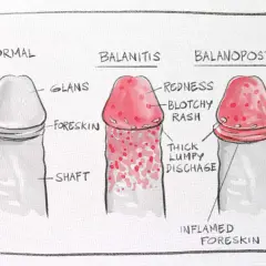 Ilustracja porównuje normalnego penisa z balanitis i balanoposthitis, pokazując objawy takie jak zaczerwienienie i wydzielina. Zrozumienie, smegma co to, jest kluczowe dla higieny.