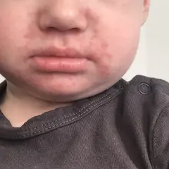 Czerwone krostki od sliny u dziecka wokół ust, widoczne na policzkach i brodzie.