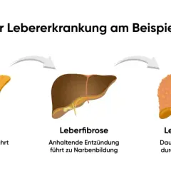 Stadien der Lebererkrankung: gesunde Leber, Fettleber (Fettablagerung führt zu Entzündung), Leberfibrose, Leberzirrhose und Leberkrebs. Was tun bei Fettleber?