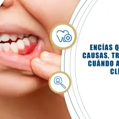 Primer plano de encías inflamadas y enrojecidas, indicando la posibilidad de encías sangrantes. El texto informa sobre causas y tratamientos.