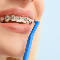 Pulizia dei denti con apparecchio, un passo fondamentale per prevenire l'alitosi. Rimedi efficaci per un sorriso smagliante.