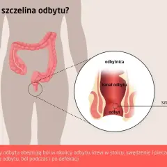 Ilustracja przedstawia anatomię odbytu z zaznaczoną szczeliną. Objawy szczeliny odbytu to ból, krwawienie i pieczenie.