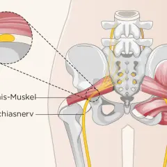 Der musculus piriformis im Beckenbereich, daneben der Ischiasnerv. Eine Nahaufnahme zeigt die Muskelfaserstruktur.