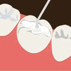 Aplicación de sellador dental para proteger contra caries y aliviar los dientes sensibles.