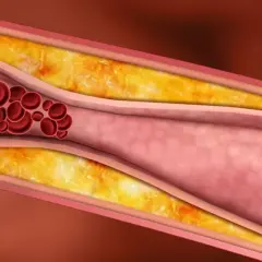 Zwężone naczynie krwionośne z blaszkami miażdżycowymi i czerwonymi krwinkami. Angiografia co to? Badanie obrazujące naczynia.