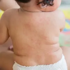Baby's Rücken zeigt einen roten Ausschlag, möglicherweise nach 3 Tagen Fieber.