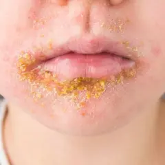 Bouche d'enfant atteinte d'impétigo, une infection cutanée qui peut causer du stress et de l'inconfort.