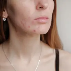 Hautunreinheiten im Gesicht und am Hals, möglicherweise nach dem Absetzen der Pille. Rote Pickel und Mitesser sind sichtbar.