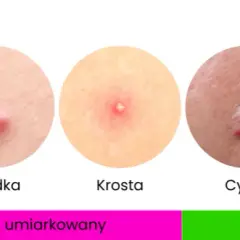 Jak pozbyć się pryszczy? Kompleksowy przewodnik po leczeniu