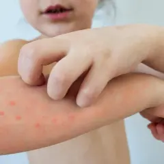 Dziecko drapie swędzące krostki na ramieniu, objawy typowe dla ospy u dzieci.
