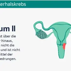 Wichtige Informationen zur Gebärmutterhalskrebs Vorsorge für Frauen
