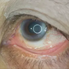 Oko z widocznymi zmianami, mogącymi wskazywać na retinopatię cukrzycową. Widoczne zaczerwienienie spojówki i drobne wybroczyny.