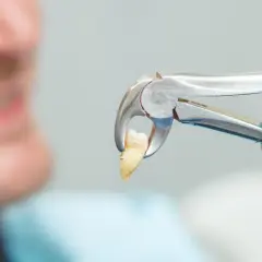 Dentysta trzyma wyjęty ząb w kleszczach. Czy po wyrwaniu zęba można iść do pracy? Zależy od samopoczucia.