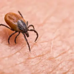 Makro zbliżenie na kleszcza wgryzionego w ludzką skórę. Pajęczak z ośmioma odnóżami przygotowuje się do pobrania krwi.