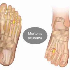 Illustrazione anatomica del piede che mostra un neuroma di Morton, una condizione che rende doloroso il camminare.