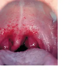 Gardło z licznymi czerwonymi wybroczynami, objaw infekcji Streptococcus pyogenes.