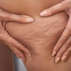 Jak pozbyć się cellulitu z ud? Skuteczne metody i porady eksperta
