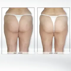 Endermologia: Kiedy efekty i jak utrzymać je na dłużej?